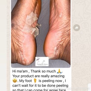 PEDI PEEL (Foot Peel)